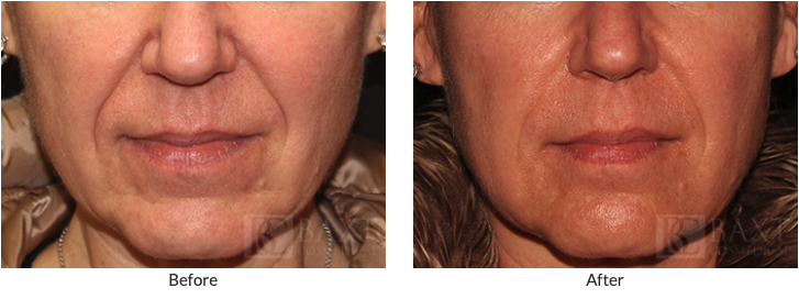 Click Here to View More Juvéderm<sup>®</sup> Before & After Photos
