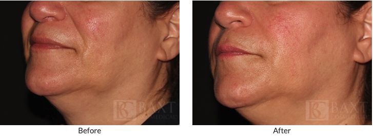 Juvéderm Voluma® XC Before and After