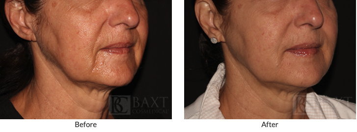 Juvéderm Voluma® XC Before and After 2