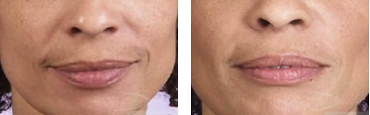 Juvéderm® injection to lips Before and After