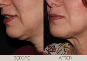 CoolSculpting® Gallery