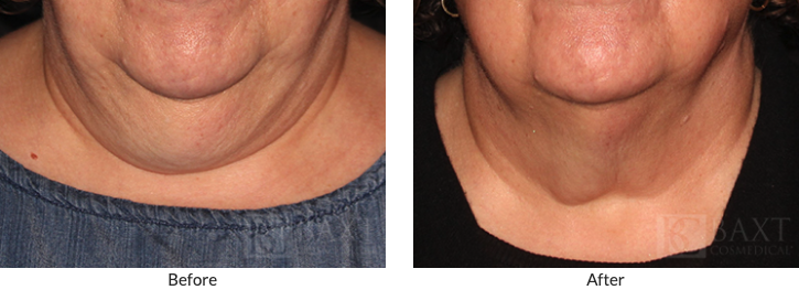 CoolSculpting - Before and After