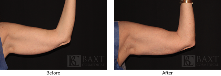 CoolSculpting Before and After 3