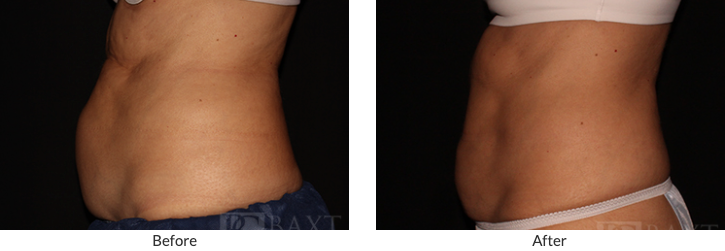CoolSculpting Before and After 3
