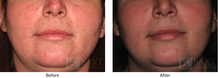 Rosacea Treatment 1