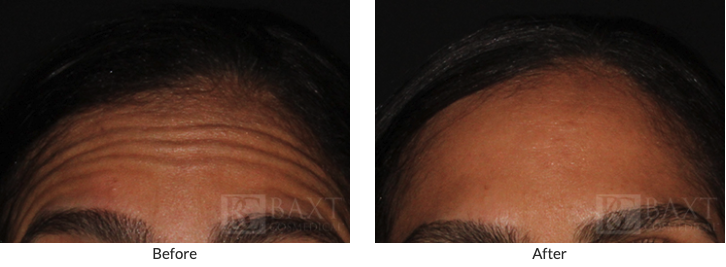 Before/After BOTOX® Cosmetic Patients