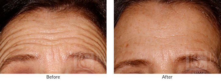Before/After BOTOX® Cosmetic Patients 2