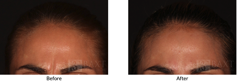 Before/After BOTOX® Cosmetic Patients 3