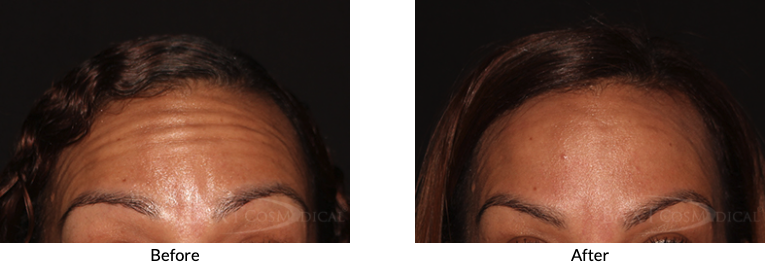 Before/After BOTOX® Cosmetic Patients 4