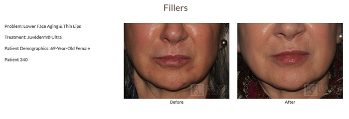 Juvederm  Before and After
