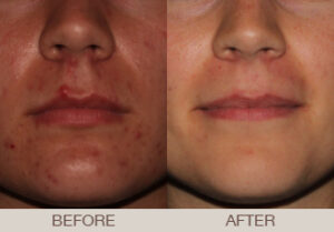 Acne Treatment Gallery