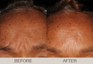 BOTOX<sup>®</sup> Cosmetic Gallery