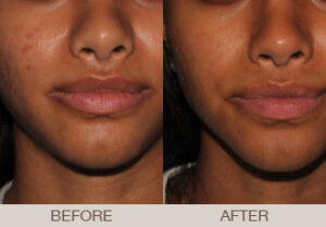 Acne Treatment Gallery