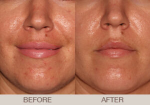 Acne Treatment Gallery