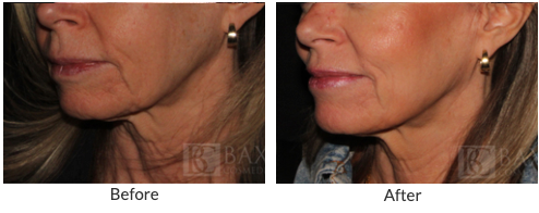 Ellacor® Before & After: Witness the Skin Tightening Difference