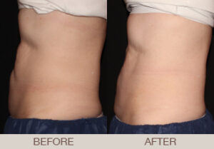 CoolSculpting® Gallery