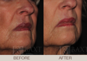Fillers Gallery