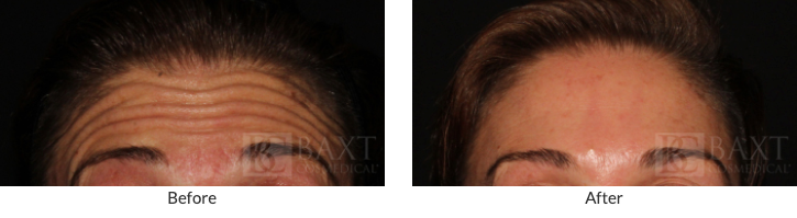 Preventing Forehead Aging in Younger Patients: Before & After