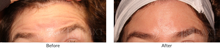 Preventing Forehead Aging in Older Patients: Before & After
