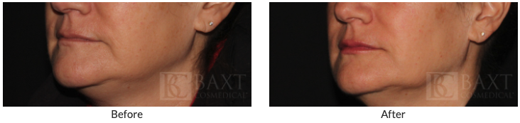 Before and After: Rejuvenate Your Face with Facial Fillers