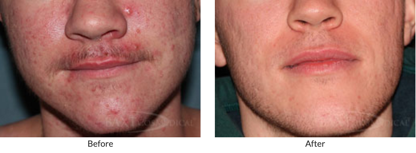 See more Before and After Acne Results