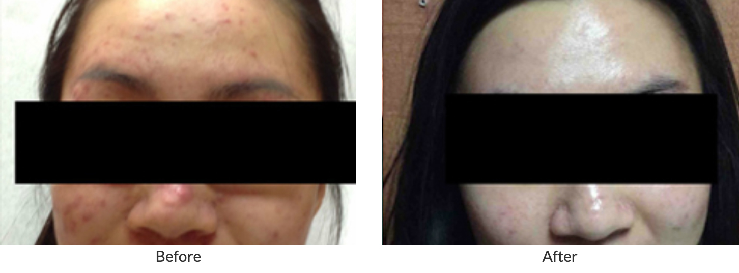See more Before and After Acne Results