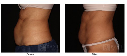 Ultherapy Before and After Ultherapy Before and After