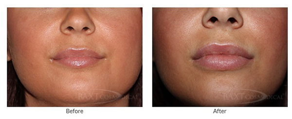 Facial Filler Before and After Facial Filler Before and After