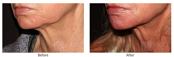 Ultherapy Before and After Ultherapy Before and After