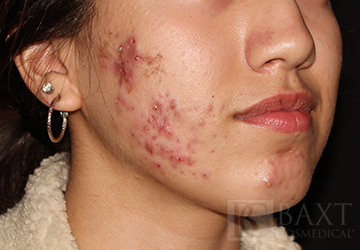 Acne Diagnosis, Treatment, & Prevention For Teens & Adults