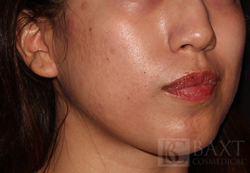 Acne Diagnosis, Treatment, & Prevention For Teens & Adults