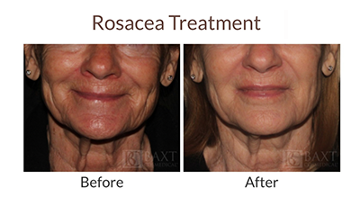 Rosacea Treatment Before and After Rosacea Treatment Before and After