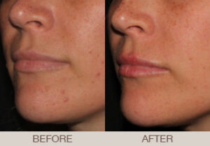 Acne Treatment Gallery