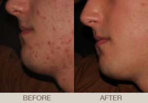 Acne Treatment Gallery