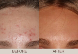 Acne Treatment Gallery