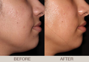 Acne Treatment Gallery