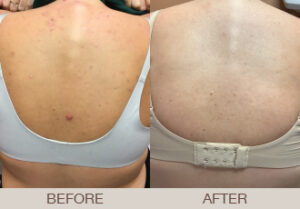 Acne Treatment Gallery