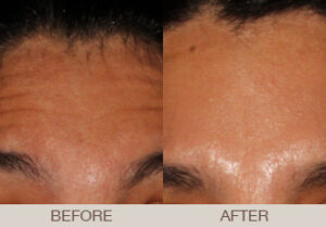 BOTOX<sup>®</sup> Cosmetic Gallery