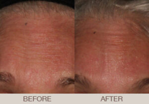 BOTOX<sup>®</sup> Cosmetic Gallery