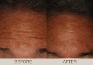 BOTOX<sup>®</sup> Cosmetic Gallery