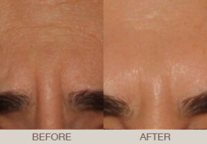BOTOX<sup>®</sup> Cosmetic Gallery
