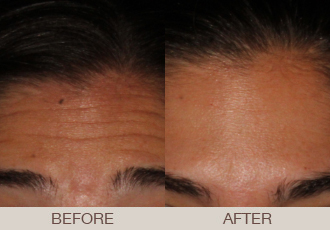 BOTOX<sup>®</sup> Cosmetic Gallery