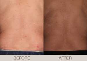 CoolSculpting® Gallery