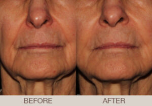 Fillers Gallery