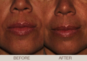 Fillers Gallery