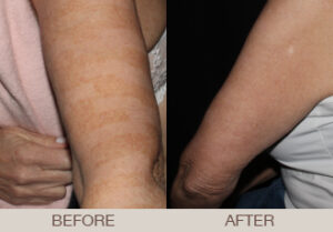Fraxel® Dual Laser Resurfacing