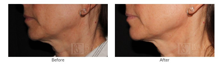 Ultherapy Before and After Ultherapy Before and After