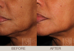 Ultherapy® Gallery