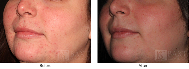 Rosacea Treatment 1