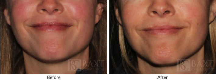See the Results of Our Rosacea Treatment
